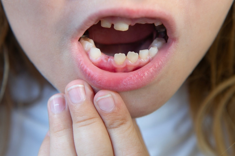 Child With Missing Teeth